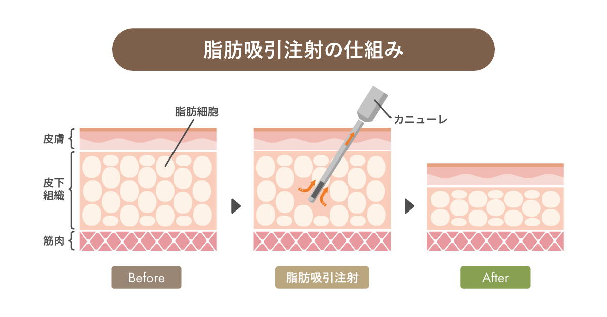 脂肪吸引注射の仕組み