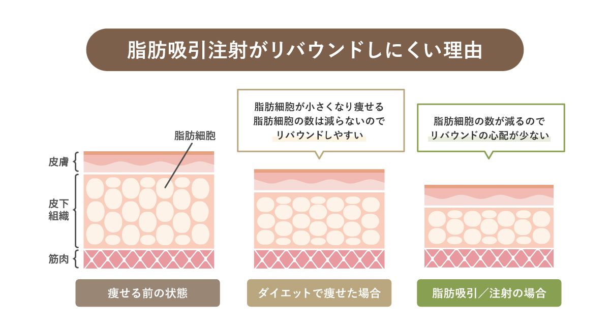 脂肪吸引注射のメリット