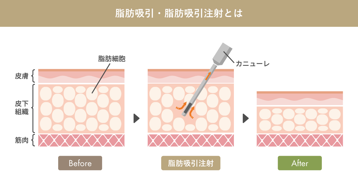 脂肪吸引／脂肪吸引注射とは