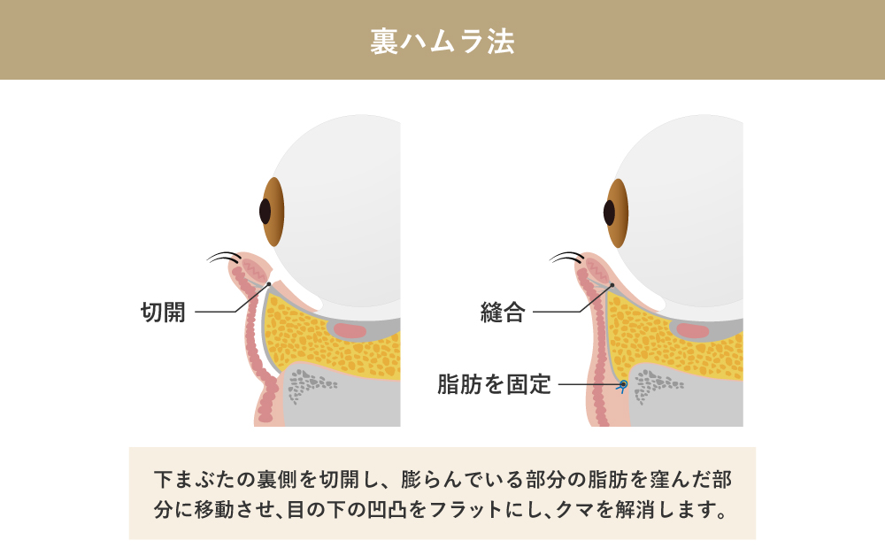 裏ハムラ法とは