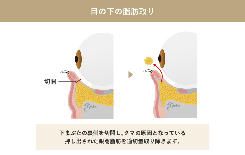 目の下の脂肪取りとは