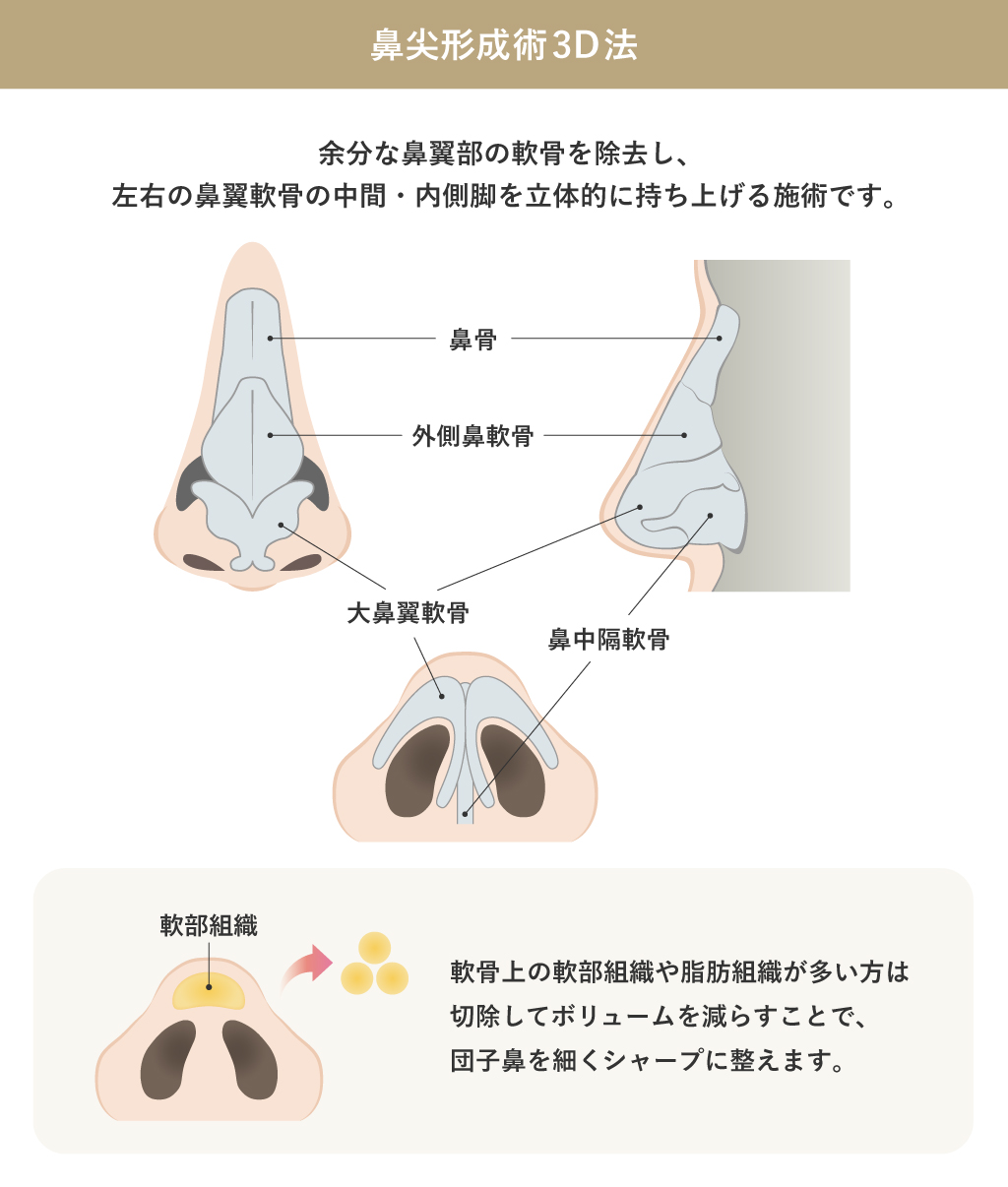 鼻尖形成3D法